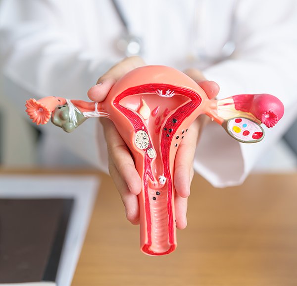 Uterine Fibroids: Symptoms, Causes, and Treatment Options Without Surgery