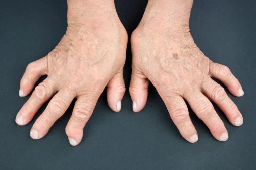 Psoriatic Arthritis vs Rheumatoid Arthritis: Key Differences