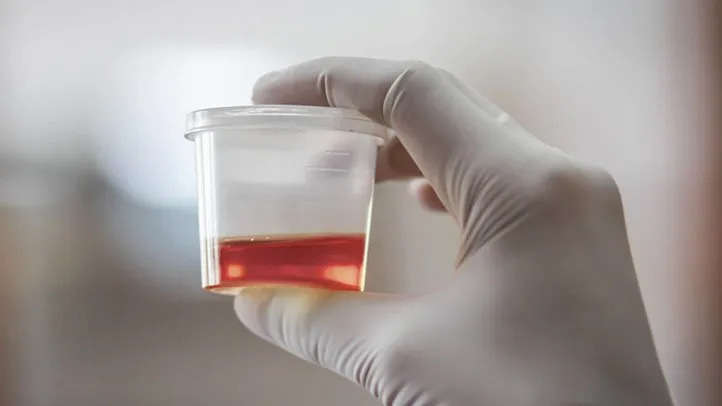 Blood in Urine: What Causes It and When It’s a Serious Warning Sign