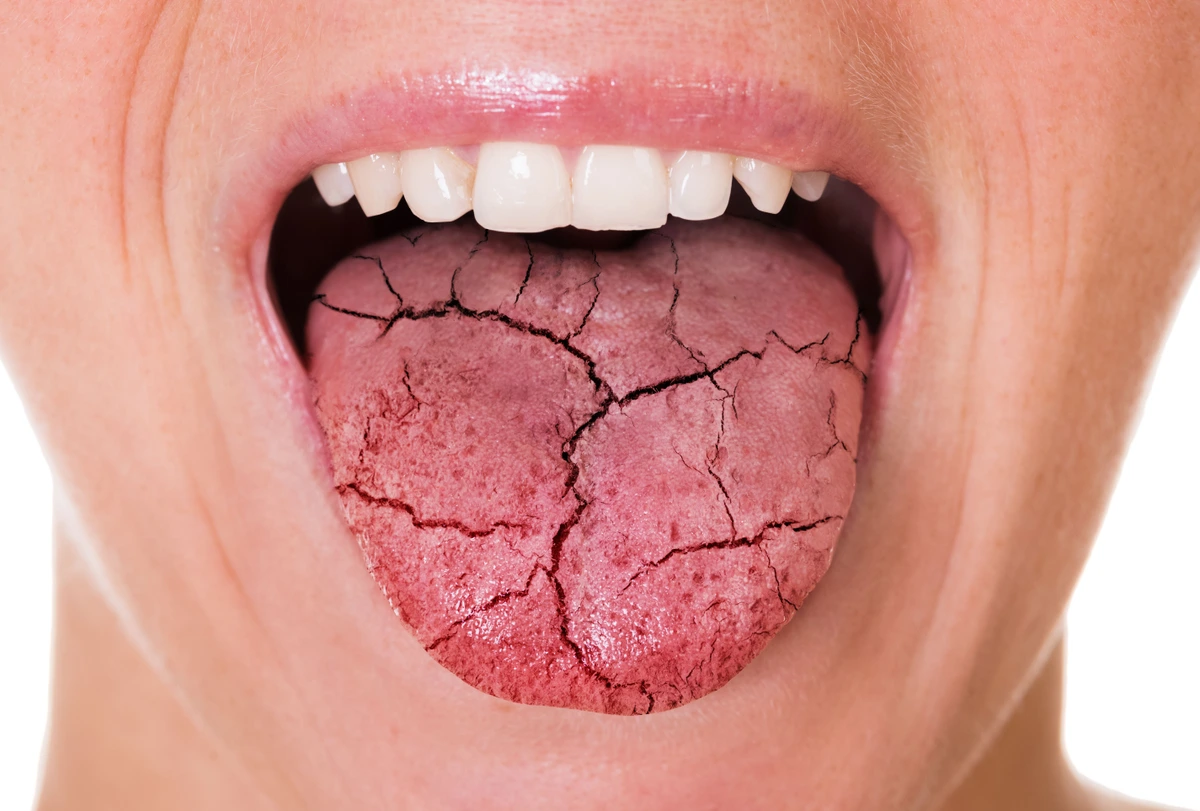 Dry Mouth: Causes and Remedies — Why It Happens and What Actually Helps