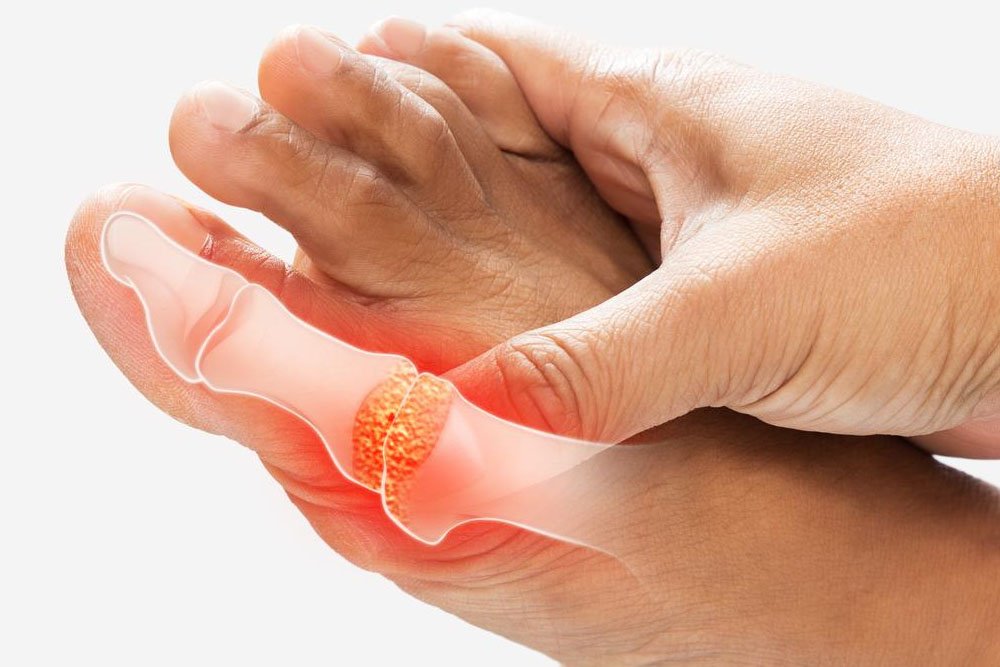 Gout Symptoms and Triggers: What to Eat (and Avoid) to Prevent Attacks
