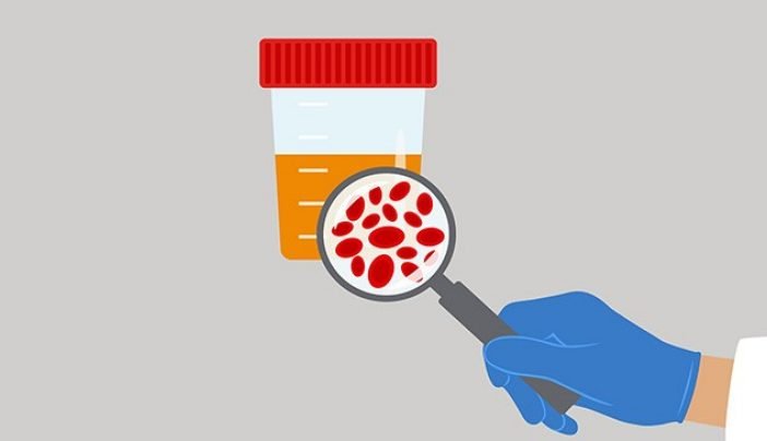Blood in Urine: What Causes It and When It’s a Serious Warning Sign