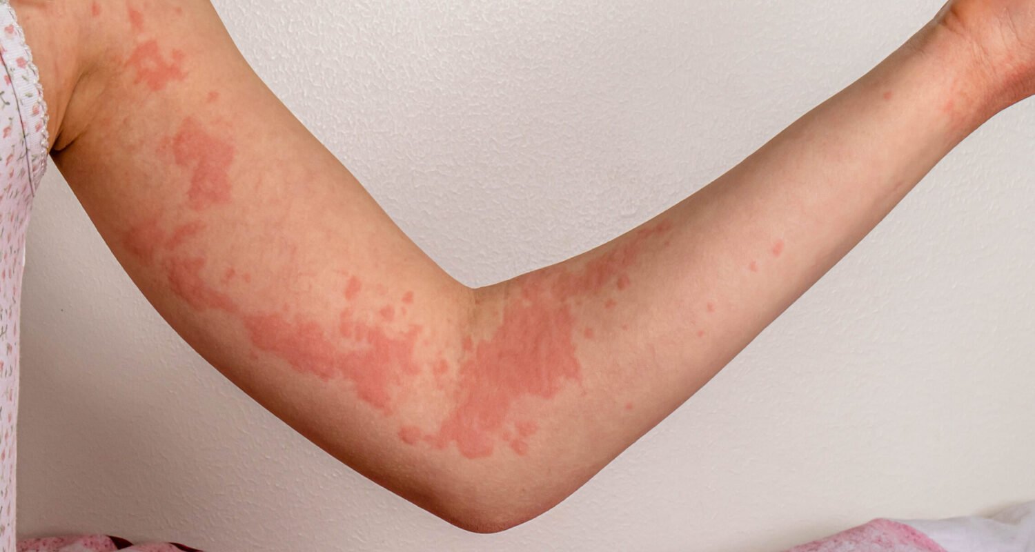 Mast Cell Activation Syndrome: Symptoms and Why It’s Often Misdiagnosed