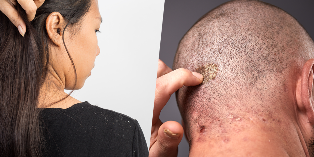 Scalp Psoriasis vs Dandruff: Why It Matters to Know the Difference