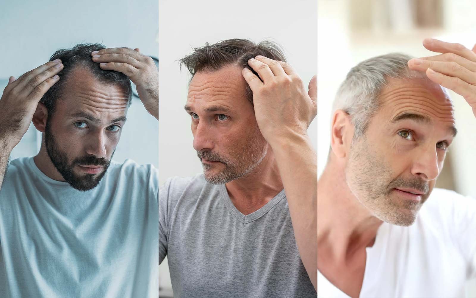 Male Pattern Baldness: What Causes It and What Treatments Actually Work in 2026