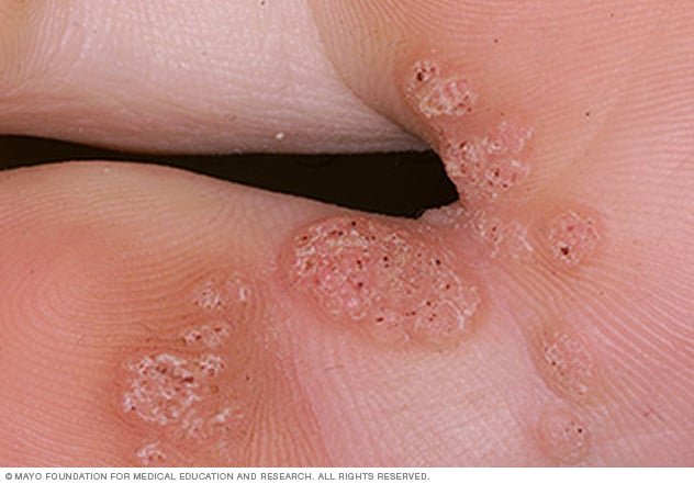 HPV in Adults: What Happens When It's Detected Later in Life?